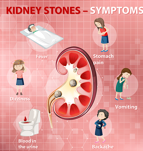 kidney stones Symptoms, Causes, and Treatment